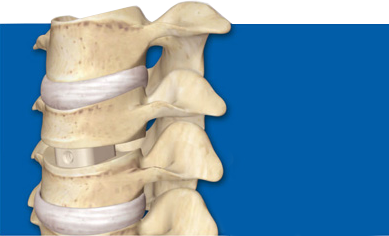 deburring back implants in PEEK